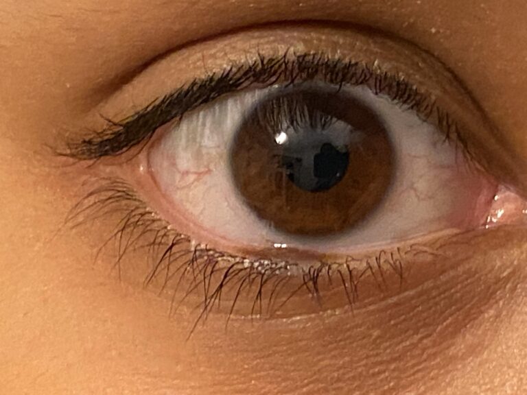 Birthmark in Eye Meaning