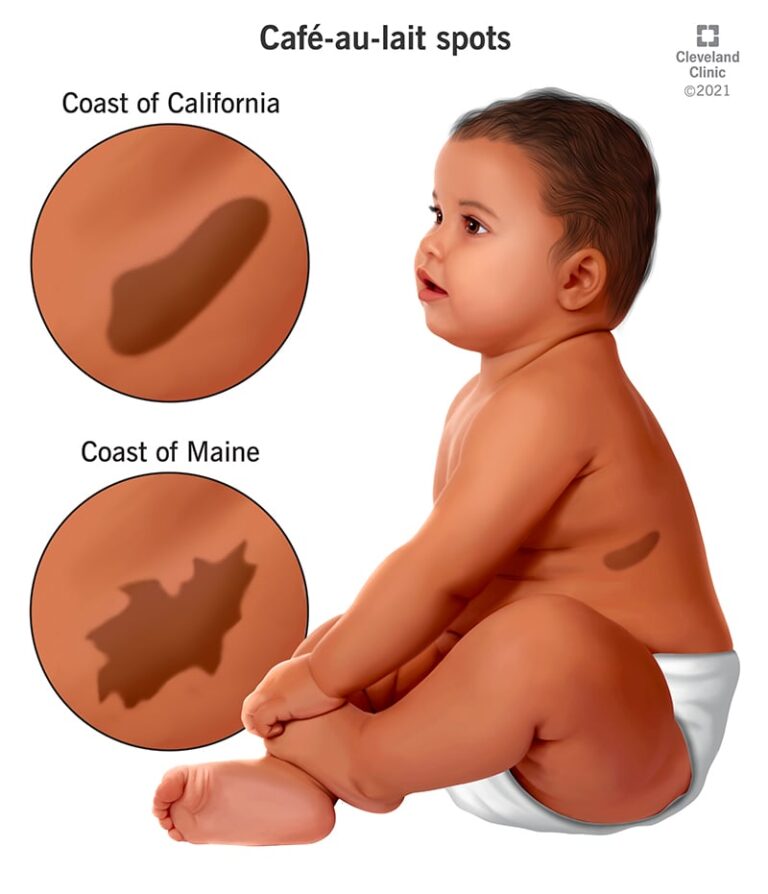 Meanings of Birthmarks Types Shapes Locations Colors