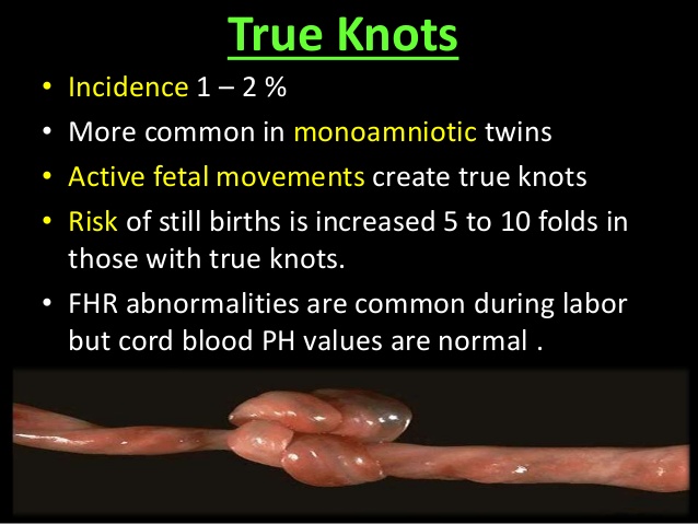 True Knot in Umbilical Cord Spiritual Meaning Superstition