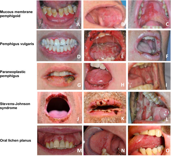 Autoimmune Diseases With Oral Manifestations