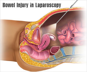 Delayed Manifestations of Laparoscopic Bowel Injury